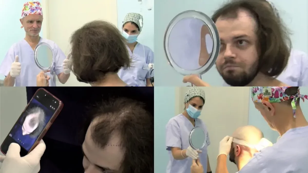 F4ea5af04e - Rejuvenecer y sonreír con un trasplante capilar