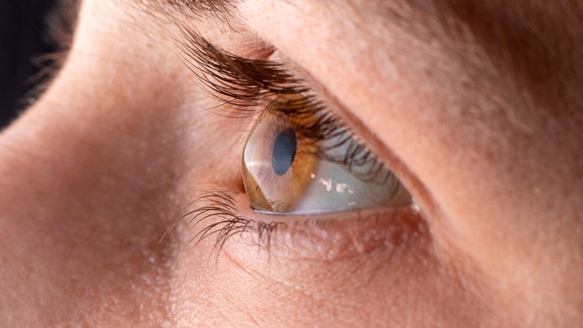 F594388d - ¿Queratocono: qué es, cómo detectarlo y por qué podrías padecerlo sin saberlo